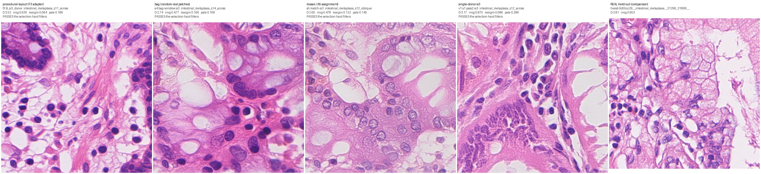 Best per family, intestinal metaplasia